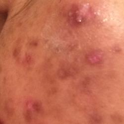 Example of acne